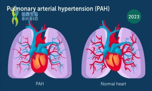 心跳的感覺 |Olink 助力肺動脈高壓患者右心室衰竭標志物 LTBP- 2 篩選