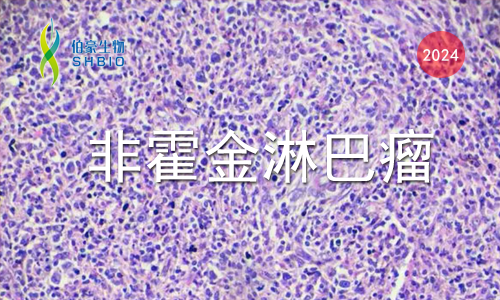 文獻(xiàn)解讀 | PD- 1 在 T 細(xì)胞淋巴瘤中相關(guān)抑制代謝程序，限制糖酵解和抑制 AP- 1 活性