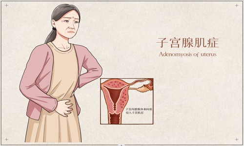 文獻(xiàn)解讀 | 單細(xì)胞 RNA 測(cè)序與空間轉(zhuǎn)錄組學(xué)相結(jié)合破譯的子宮腺肌病綜合轉(zhuǎn)錄圖譜